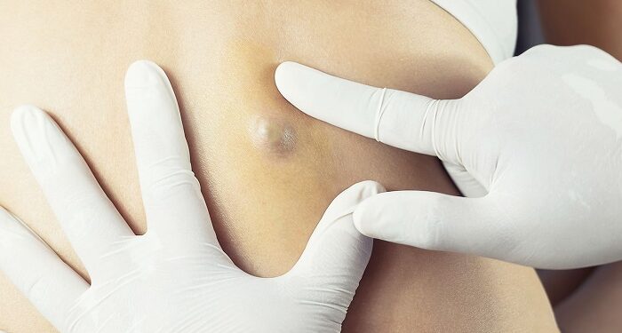 Удаление доброкачественных новообразований, таких как жировики