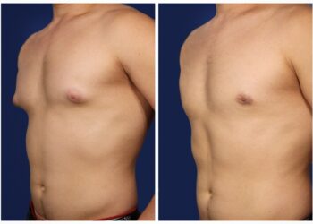 Видалення гінекомастії: покази та протипокази до операції