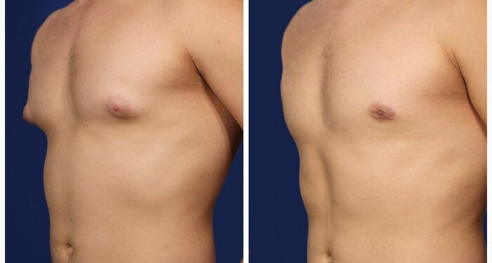 Видалення гінекомастії: покази та протипокази до операції