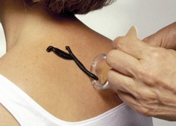 Аптечные пиявки: правила применения и польза для организма