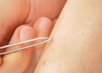 Як ефективно видаляти вросле волосся після гоління: правила та рекомендації