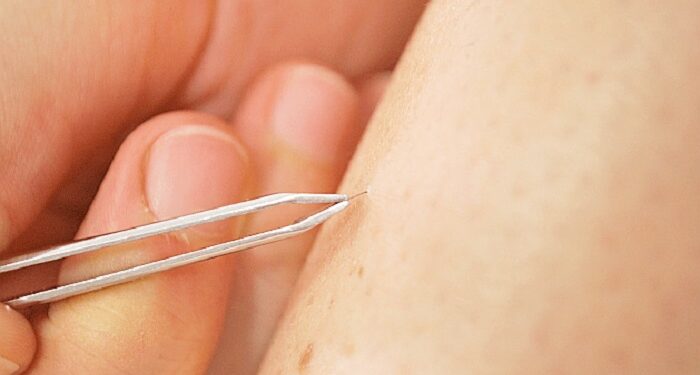 Як ефективно видаляти вросле волосся після гоління: правила та рекомендації